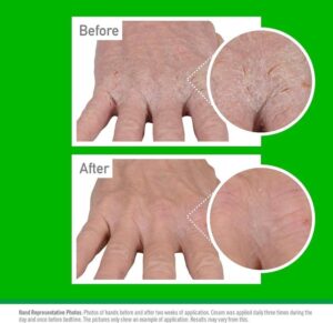O Keeffe S Working Hands Eczema Relief Hand Cream 57g For Extremely Dry Itchy Ir