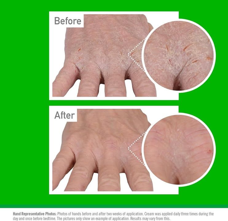 O Keeffe S Working Hands Eczema Relief Hand Cream 57g For Extremely Dry Itchy Ir